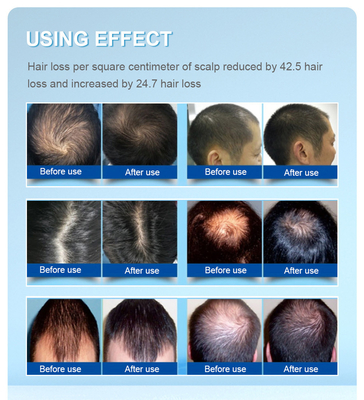 rotes helles 200 Dioden-Haarausfall-Behandlungs-Laser-Sturzhelm-Haar-Wachstum 650nm Lllt